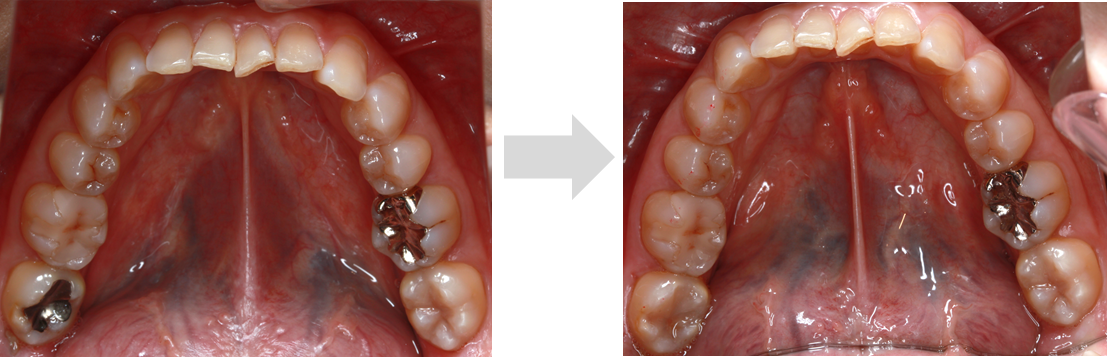 銀歯を白い歯に ダイレクトボンディング法 国立 国分寺 武蔵境 三鷹の歯科 歯医者 症例集